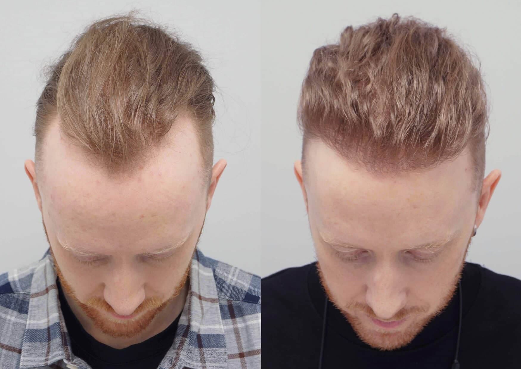 Why Choose Westminster Medical Group® for Your Hair Transplant London