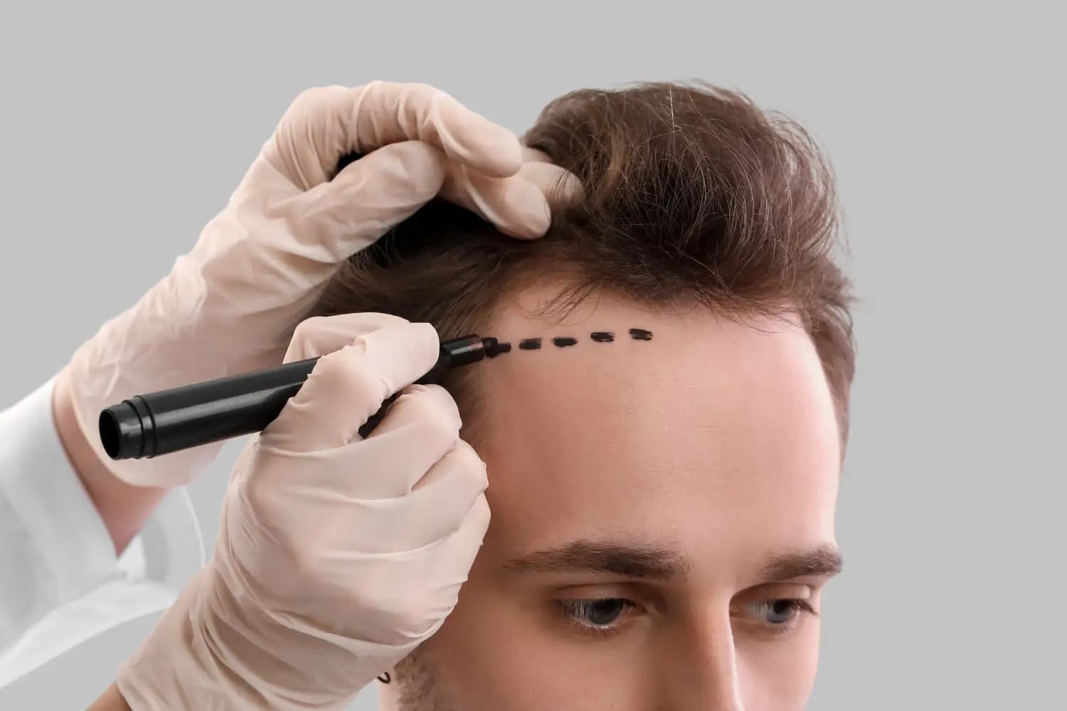 Top-Rated Hair Transplant Turkey Services in 2026