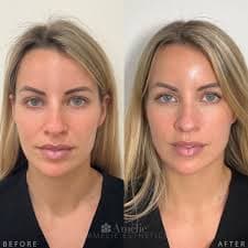 HarmonyCA Treatment for Collagen Stimulation