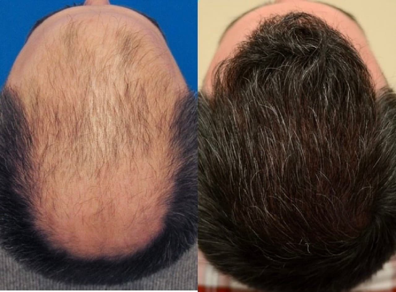 Why Choose Westminster Medical Group® for Your Hair Transplant London