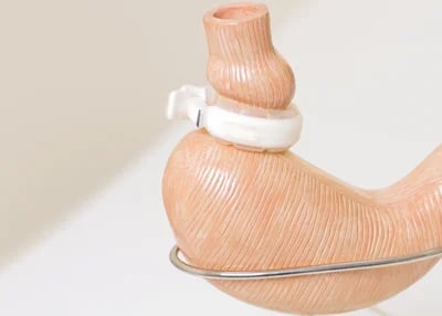 Magenverkleinerung Türkei Kosten – Transparente Preise für eine hochwertige Behandlung